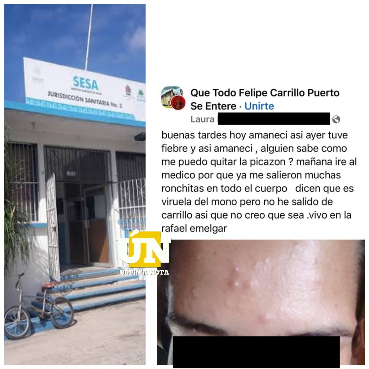 No te alarmes, SESA informa que no hay casos de viruela símica en Carrillo