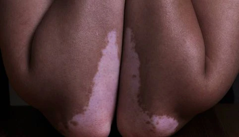 Surge nueva esperanza para personas con vitiligo en Europa; aprueban primera crema que ayuda a la repigmentación