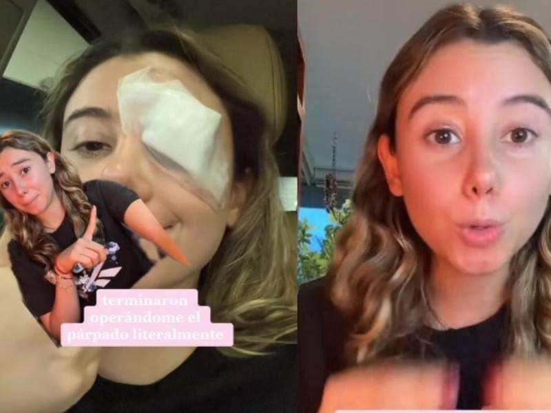 Tras Hack de belleza de TikTok se daña el párpado