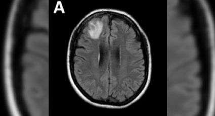 Fue al doctor por dolor de estómago, pero tenía un peligroso parásito de 8 centímetros en el cerebro
