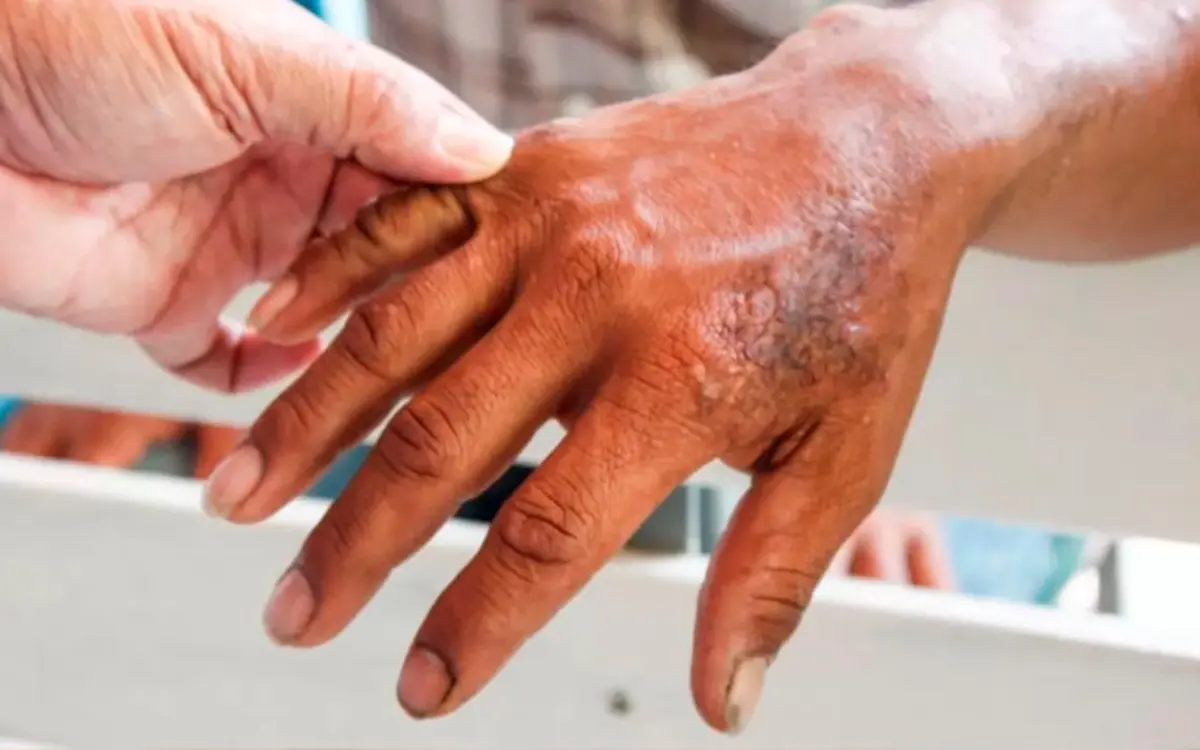 ¿Cómo se contagia la lepra?, enfermedad prioritaria en 12 municipios de México