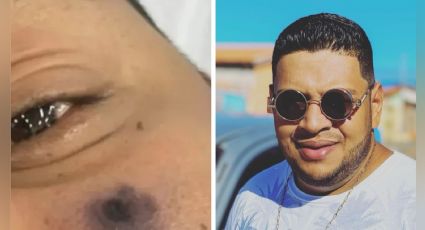 Insólito: muere famoso cantante brasileño tras ser picado en el rostro por una peligrosa araña