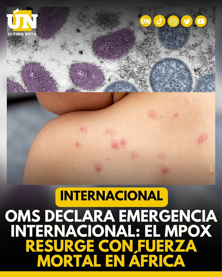 OMS declara emergencia internacional: El Mpox resurge con fuerza mortal en África