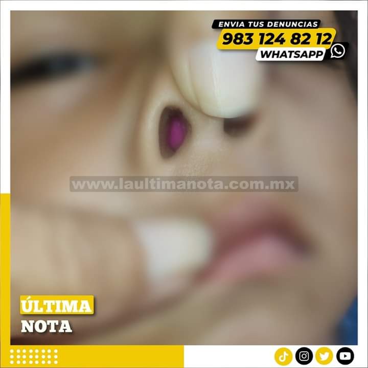 Niña de 4 años moviliza a bomberos y Cruz Roja en Felipe Carrillo Puerto tras introducir una bolita de plástico en su nariz