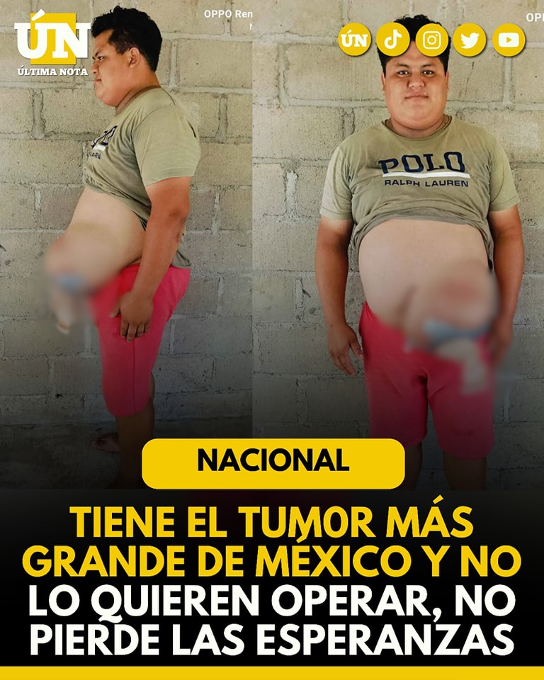 César Antonio Miranda es un joven de 28 años originario del Ejido San Mateo en  Cunduacán Tabasco y tiene el tumor más grande de México ( 17 kilos ).