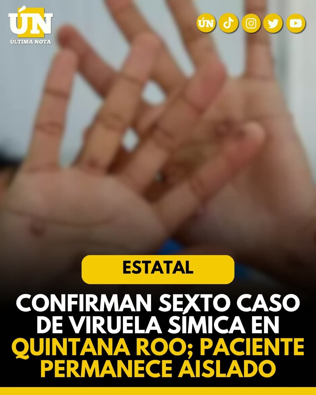 Confirman sexto caso de viruela símica en Quintana Roo; paciente permanece aislado.