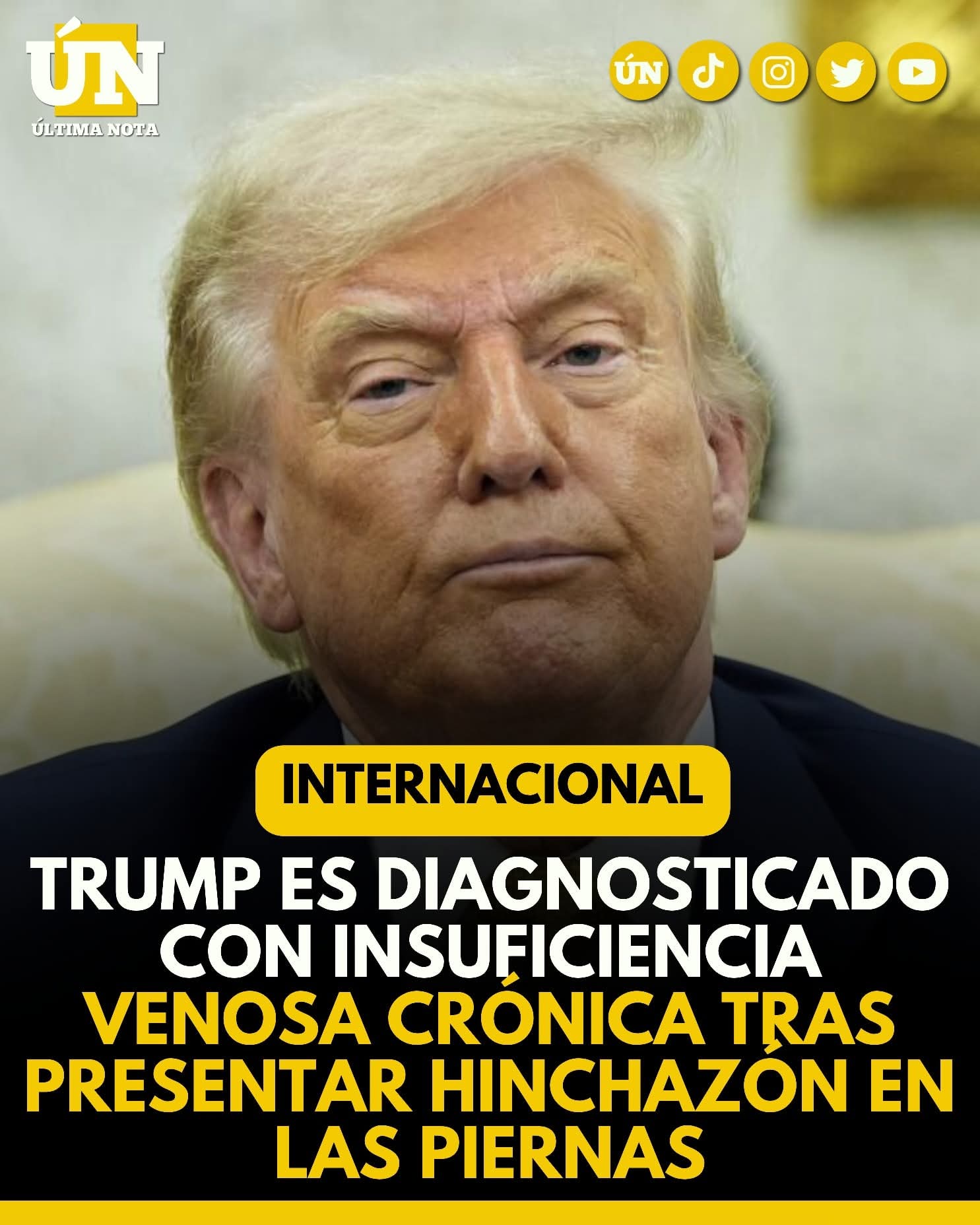 Trump es diagnosticado con insuficiencia venosa crónica tras presentar hinchazón en las piernas.