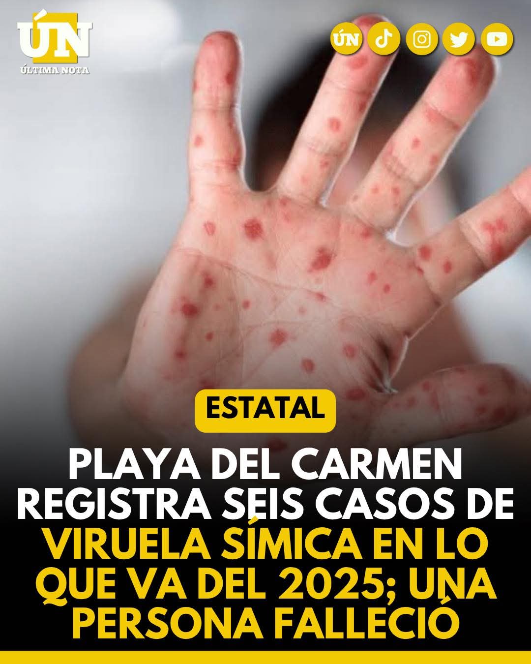 Playa del Carmen registra seis casos de viruela símica en lo que va del 2025; una persona falleció.