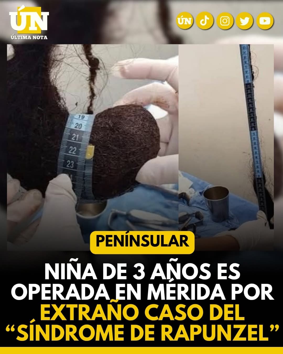 NIÑA DE 3 AÑOS ES OPERADA EN MÉRIDA POR EXTRAÑO CASO DEL “SÍNDROME DE RAPUNZEL”.