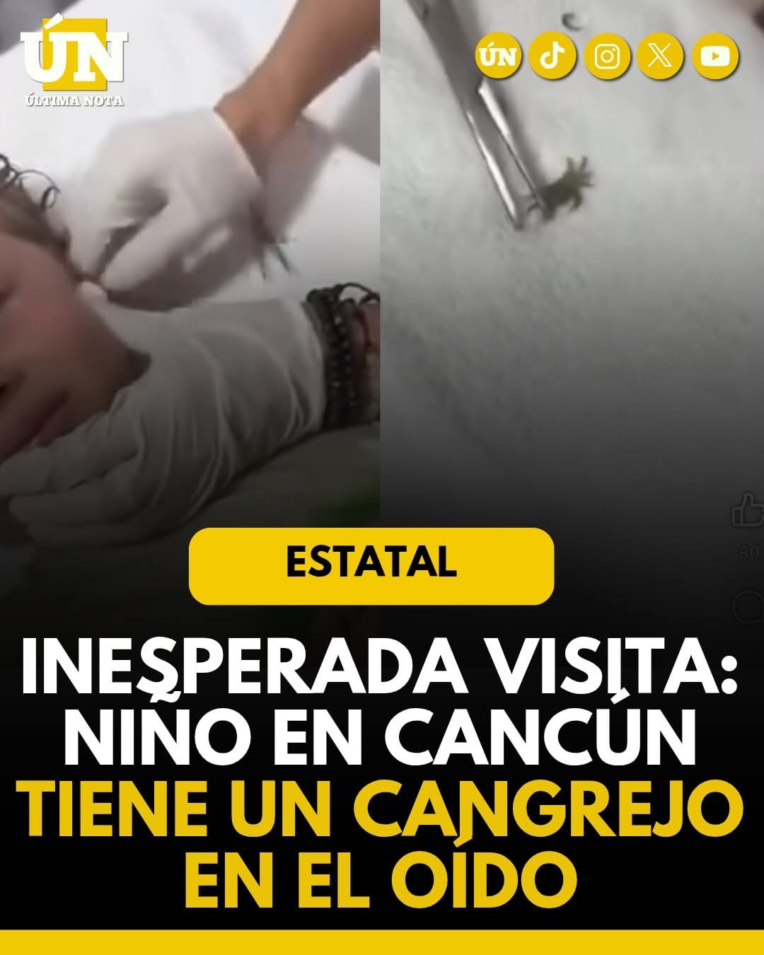 Inesperada visita: niño en Cancún tiene un cangrejo en el oído.